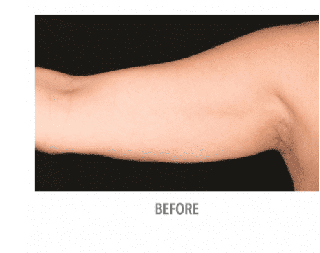 arm-5