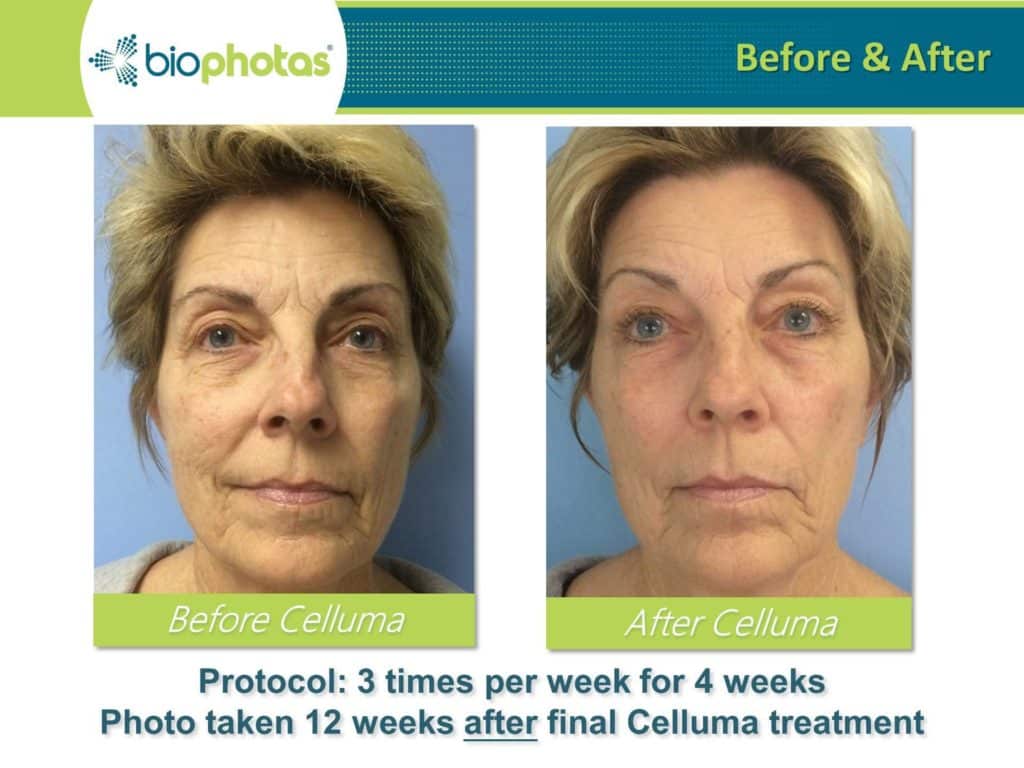 a photo of a woman before and after celluma light therapy treatment