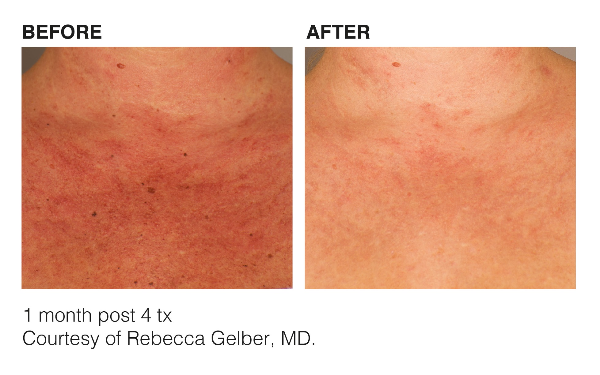 Effective Acne Treatments for Clear Skin in Cedar Rapids, IA – Cosmetic