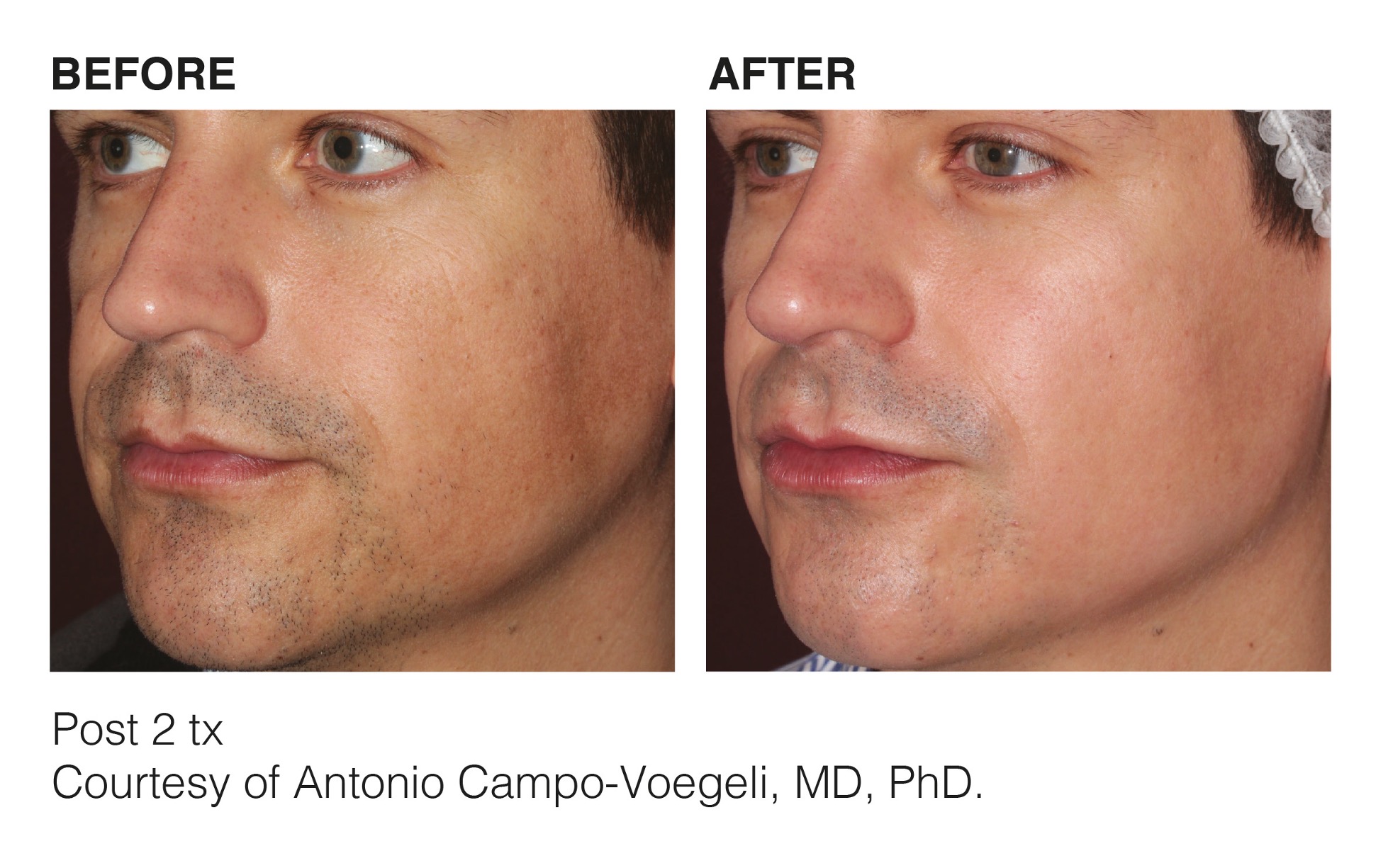 Effective Acne Treatments for Clear Skin in Cedar Rapids, IA – Cosmetic