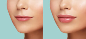 Lip Fillers | Cosmetic Solutions Laser & Skin Care Center